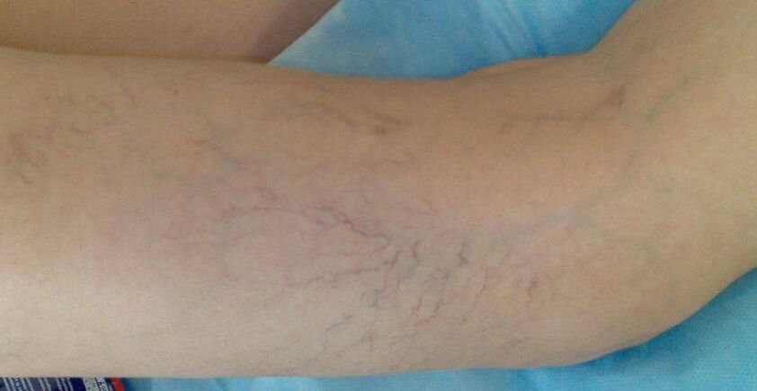 Stelle vascolari sulle gambe