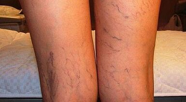 Come trattare l'espansione del varicone sulle donne nelle donne