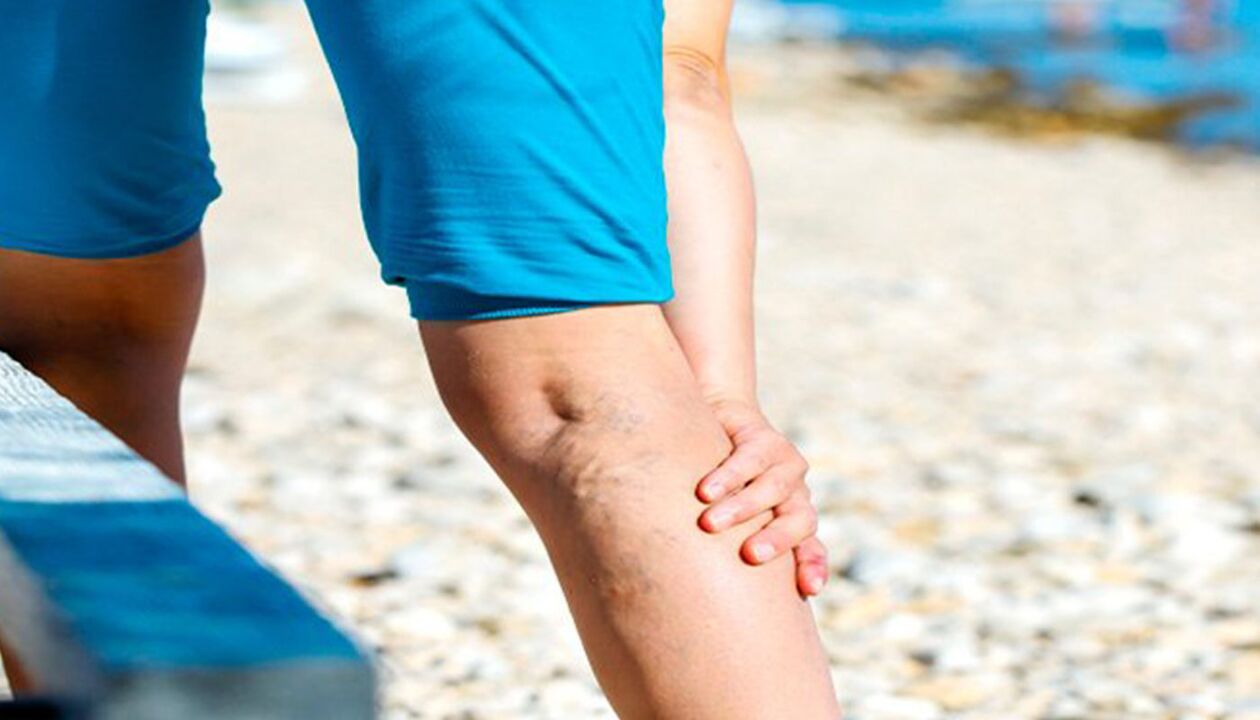 dolore alle gambe con vene varicose